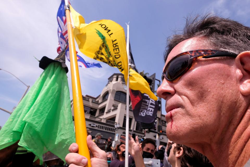 A protester with blood from a cut lip after fighting with other protesters is seen during a White Lives Matter protest in Huntington BeachREUTERS