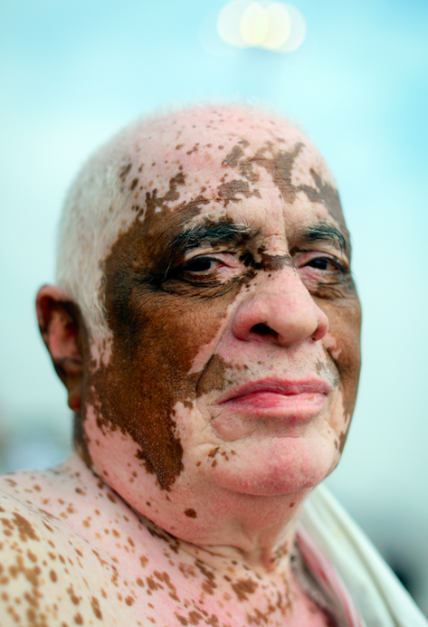The man in this photo was born with Vitiligo, a disorder in which white patches appear on different parts of the body. These patterns usually develop symmetrically across bodies and faces.