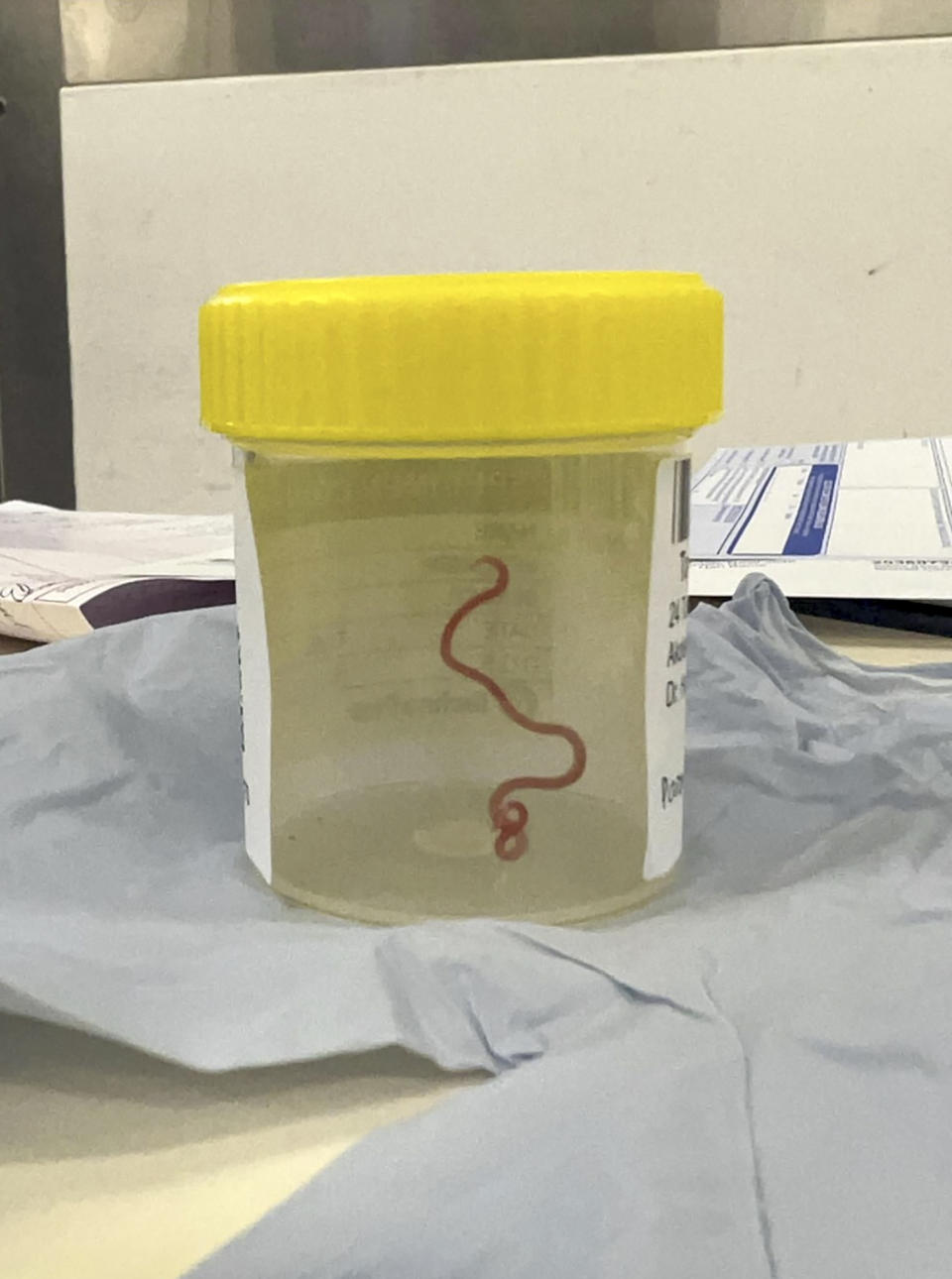 This undated photo supplied by Canberra Health Services, shows a parasite in a specimen jar at a Canberra hospital in Australia. A neurosurgeon investigating a patient's mystery neurological symptoms in an Australian hospital has been surprised to pluck a 3-inch wriggling worm from her brain. (Canberra Health Services via AP)