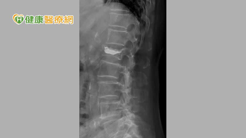 <strong>患者第一節腰脊椎(L1)，為骨質疏鬆合併脊椎壓迫性骨折，經治療，灌入骨水泥支撐塌陷的椎體後，復原狀況良好。（圖／健康醫療網）</strong>