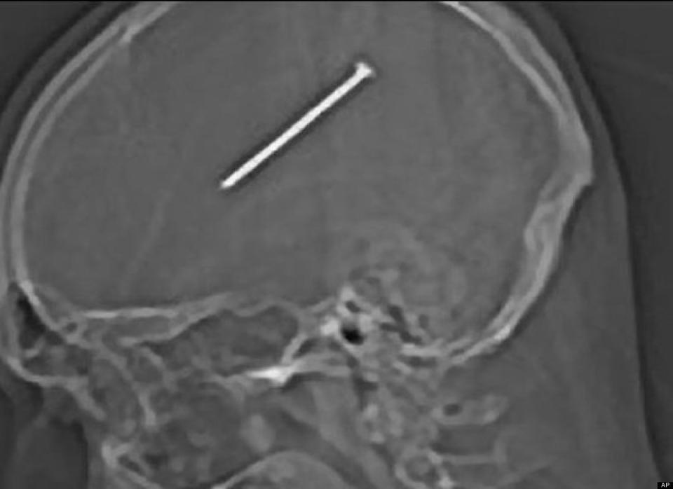 Dante Autullo, a 32-year-old Chicago man, accidentally shot a 3.5 inch nail in his brain and didn't notice for more than 24 hours.  In January of 2012, doctors at Advocate Christ Medical Center successfully removed the nail and replaced a piece of his skull with a mesh patch and titanium plate.