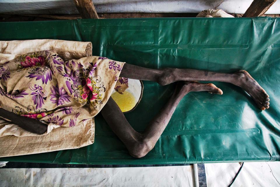 Duor Jany, 11, seriously affected with cholera, lays on a bed, at a&nbsp;clinic in Lankien, Jonglei, South Sudan on July 5, 2017. (Photo: ALBERT GONZALEZ FARRAN via Getty Images)