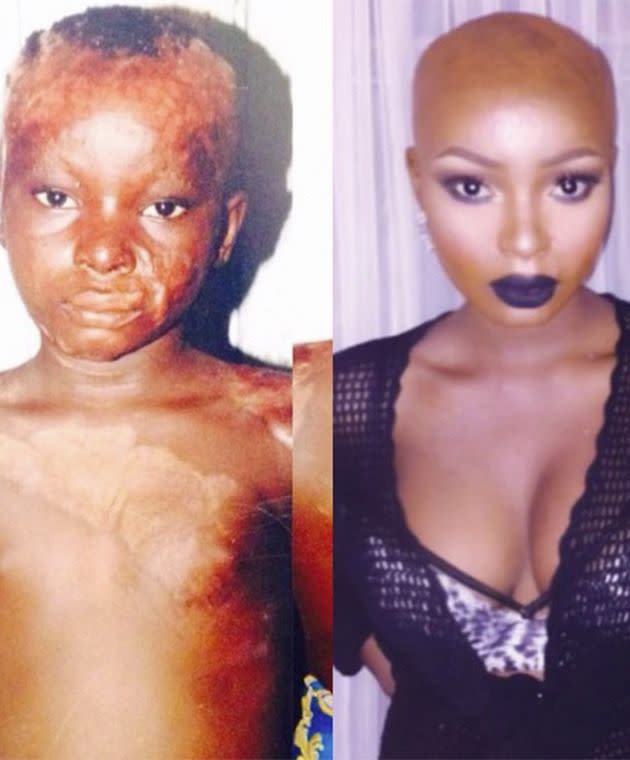 Shalom was involved in an accident as a child which left her with severe burns and scarring. Photo: Instagram/makeupbyshalom.