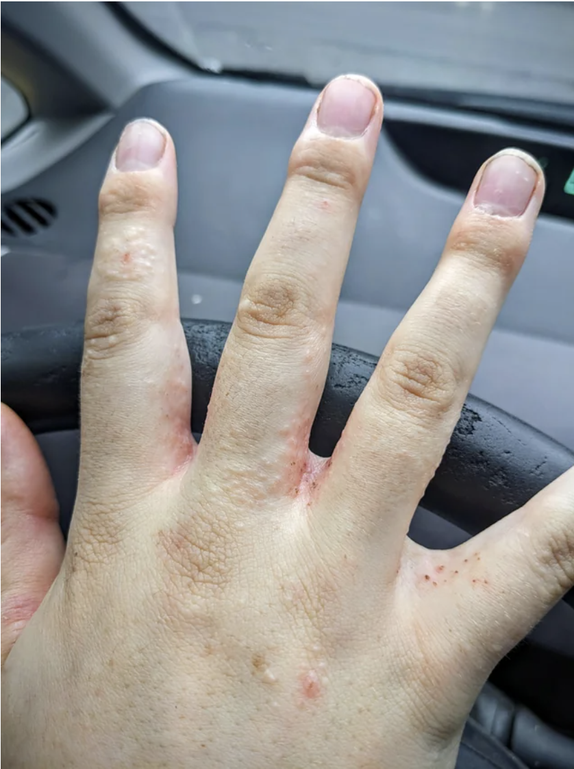 closeup of the hand with red bumps