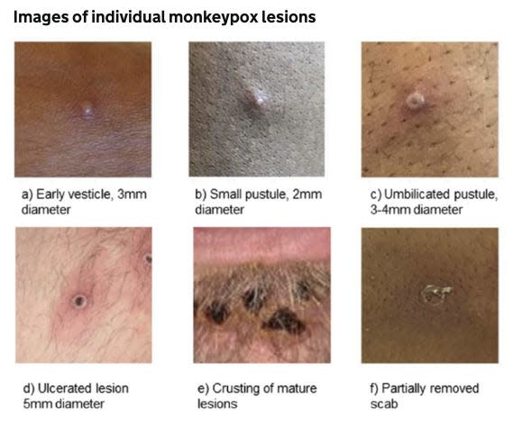 monkeypox lesions of different types