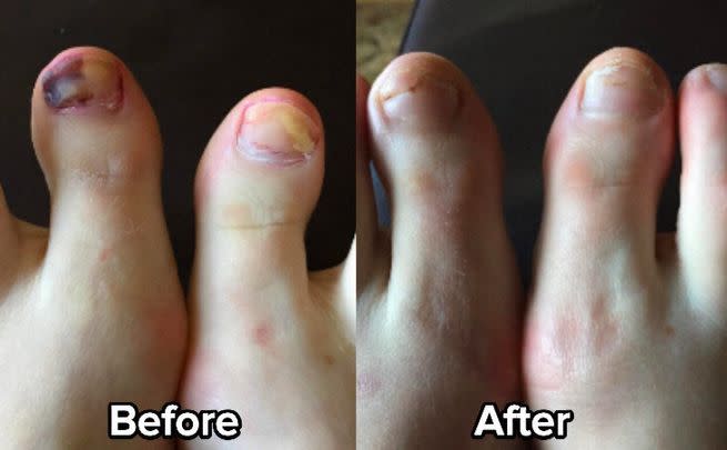 An anti-fungal toenail treatment