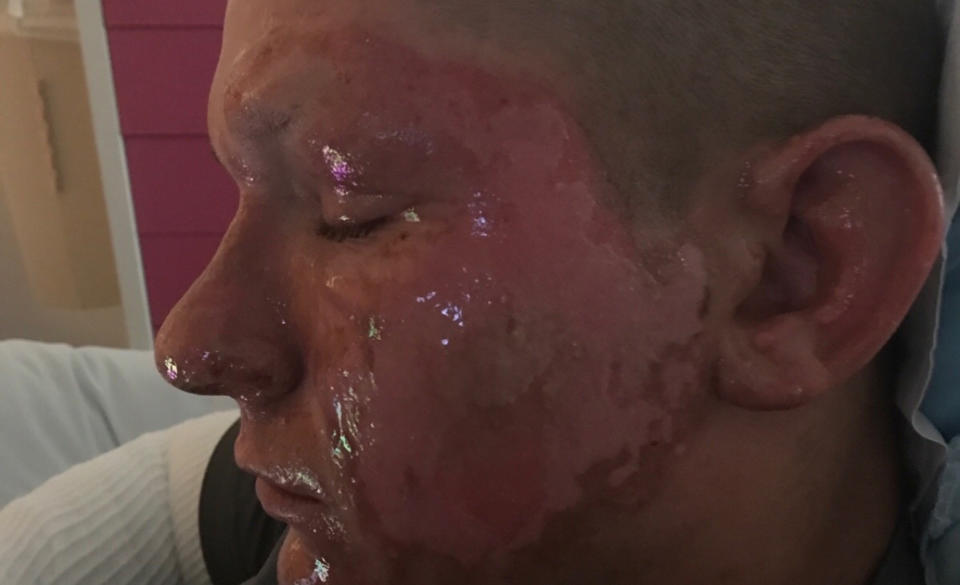 Alex Childress suffered from third-degree burns after handling giant hogweed. (Photo: <a href="https://www.gofundme.com/alexs-burn-recovery-fund" rel="nofollow noopener" target="_blank" data-ylk="slk:GoFundMe;elm:context_link;itc:0;sec:content-canvas" class="link ">GoFundMe</a>)