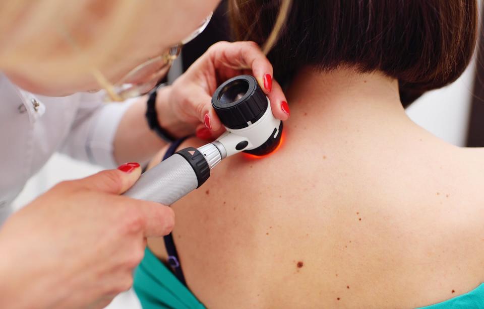 The vaccine stimulates an immune response against cancer cells. <a href="https://www.shutterstock.com/image-photo/dermatologist-examines-moles-acne-patient-dermatoscope-784036480" rel="nofollow noopener" target="_blank" data-ylk="slk:Shutterstock;elm:context_link;itc:0;sec:content-canvas" class="link ">Shutterstock</a>