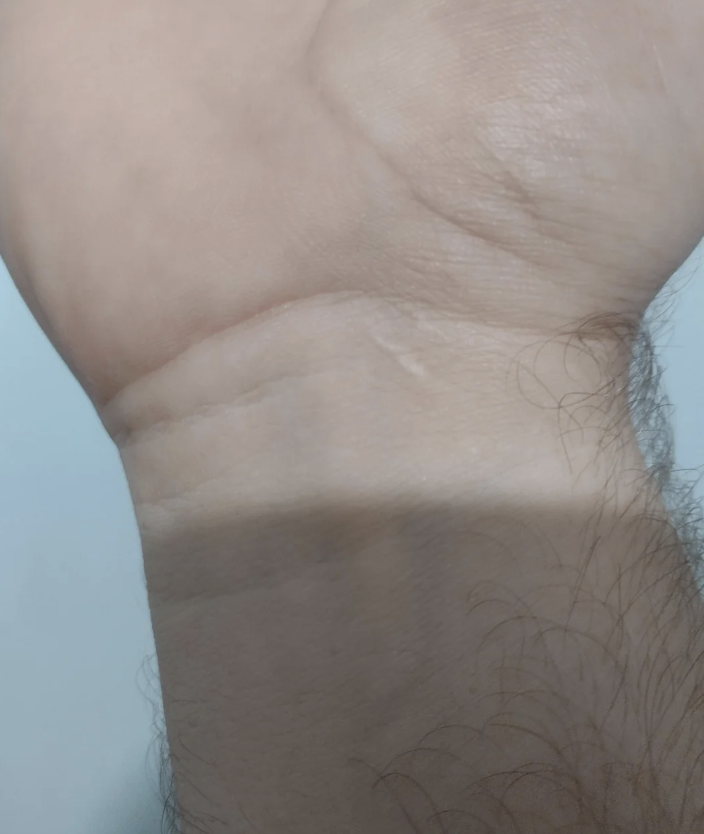 Close-up of a person's wrist showing skin folds and a few hairs