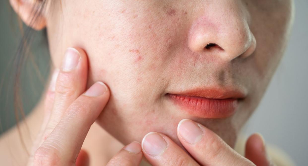 Skin problem food intolerance. (Getty Images)