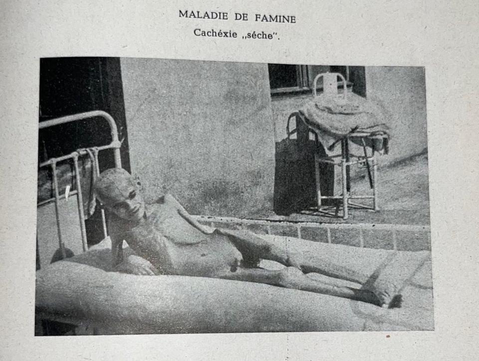 Many of the ghetto’s inhabitants had no other diseases beyond the effects of starvation. 'Maladie de Famine,' American Joint Distribution Committee