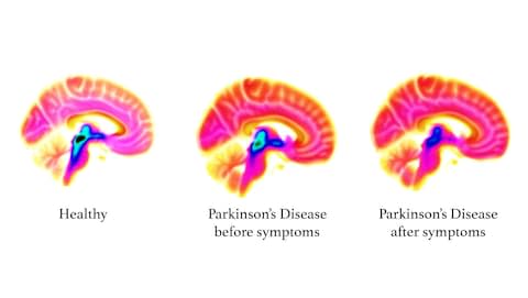 Brain imaging showing loss in serotonin function as Parkinson's disease progresses - Credit: Neurodegeneration Imaging Group, King's College London&nbsp;