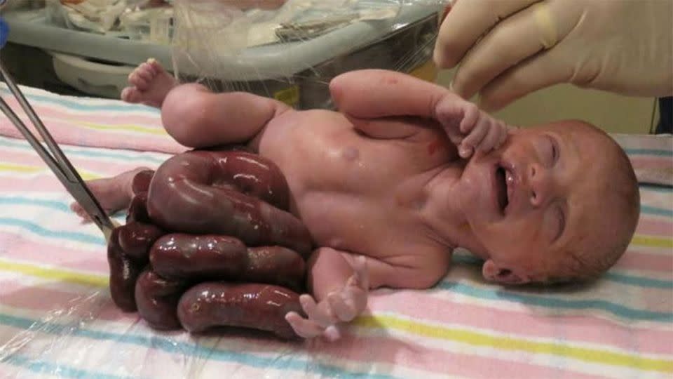 Little Teddy was born with his intestines protruding from his stomach on December 14. Photo: Supplied