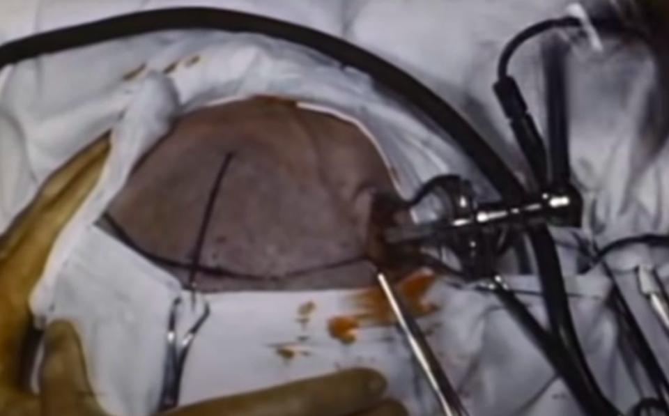 Footage of doctors performing a lobotomy on a patient by prying open his skull.