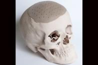 <p>The <a href="http://www.nature.com/news/the-printed-organs-coming-to-a-body-near-you-1.17320" rel="nofollow noopener" target="_blank" data-ylk="slk:3D-printed skull implant;elm:context_link;itc:0;sec:content-canvas" class="link ">3D-printed skull implant</a> was approved by the FDA in 2013. <i>(Photo: Oxford Performance Materials)</i></p>