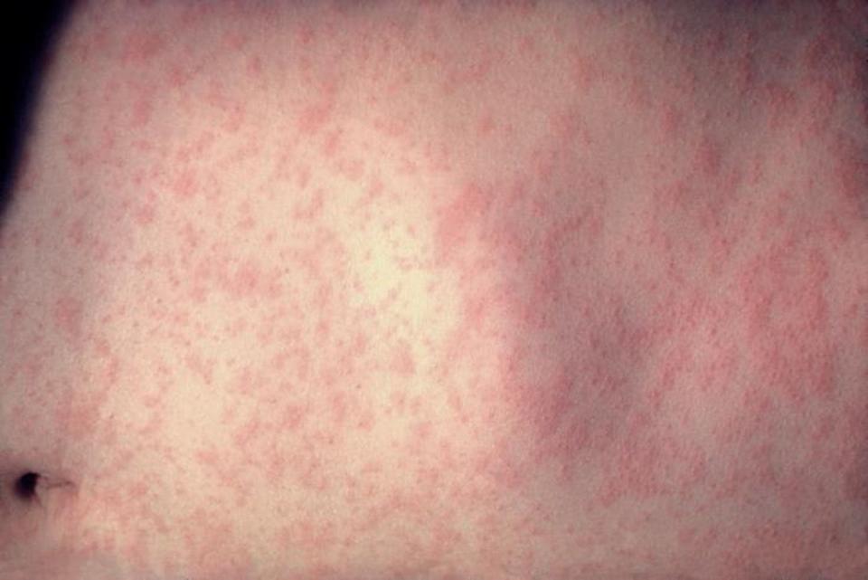 One characteristic measles symptom is a rash that spreads from the face to the rest of the body. <a href="https://phil.cdc.gov/details.aspx?pid=3168" rel="nofollow noopener" target="_blank" data-ylk="slk:CDC/Heinz F. Eichenwald, MD;elm:context_link;itc:0;sec:content-canvas" class="link ">CDC/Heinz F. Eichenwald, MD</a>