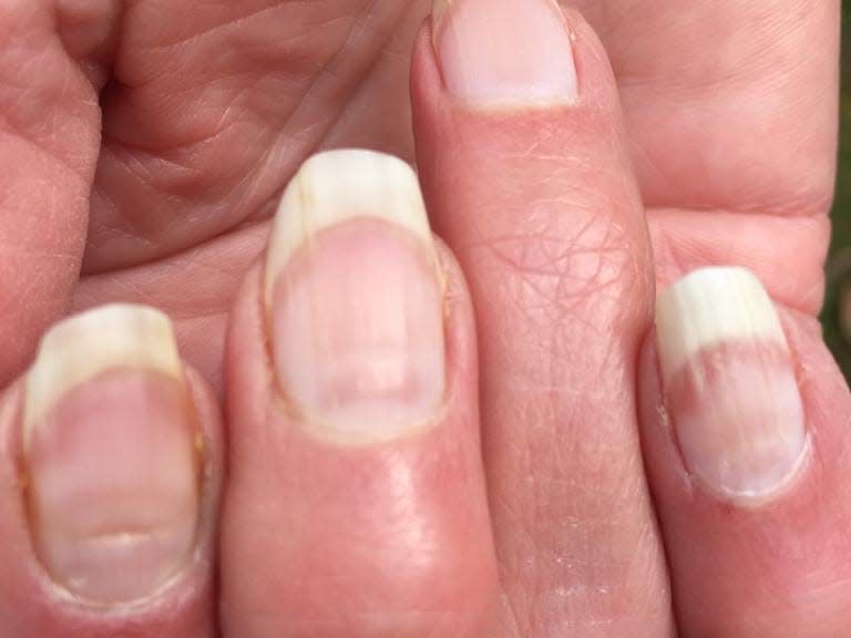 Horizontal lines across fingernails referred to as ' COVID nails'