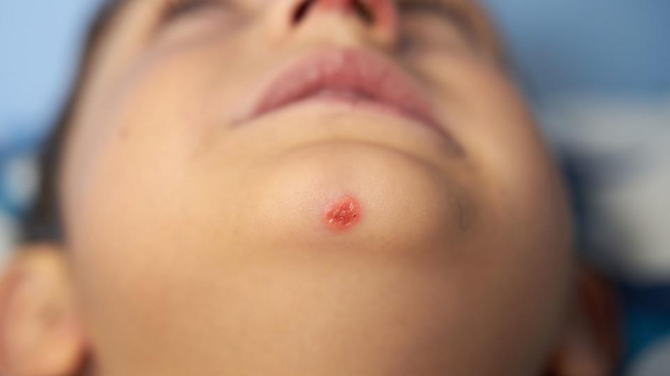 impetigo sores that form in a wound on the nose and chin