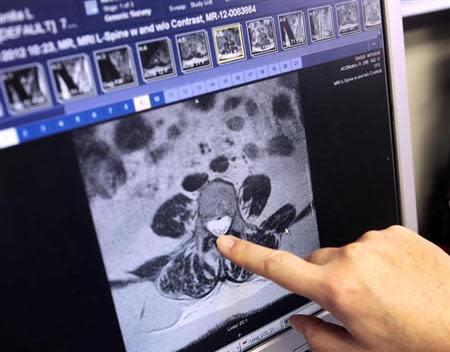 Dr. David Vandenberg shows a digital slide on his computer screen of a patients MRI showing the infected area of the spine, due to a contaminated steroid infection, at the Fungal Outbreak Clinic at St. Joseph Mercy Ann Arbor hospital in Ypsilanti, Michigan December 21, 2012. REUTERS/Rebecca Cook