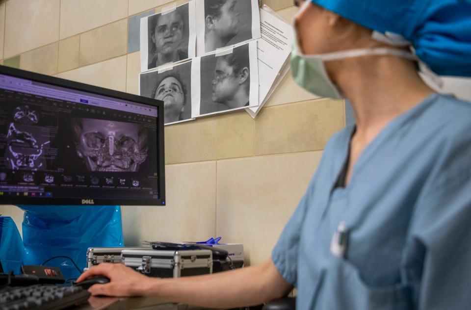 An integrated plastic surgery resident, Emily Graham, looks at a CT scan of Amedy Dewey's cranial during a facial reconstruction surgery inside the University of Michigan C.S. Mott Children's Hospital in Ann Arbor on Monday, July 24, 2023.