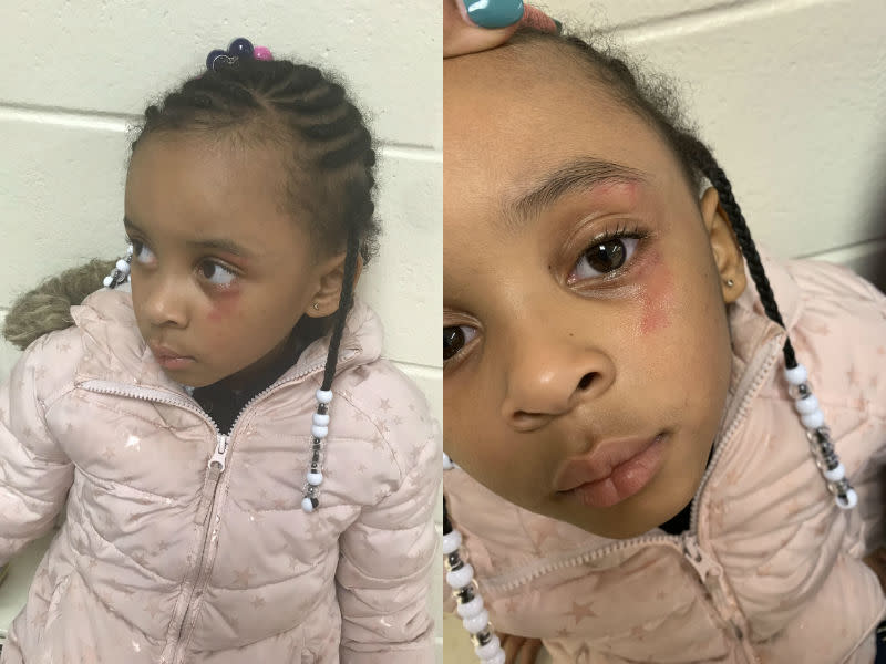 Hailey Turner told her mom that she was hit in the eye by her teacher. (Photo courtesy of Ciara Morgan)