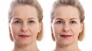 Before-After-Facelift-Stock-Photo