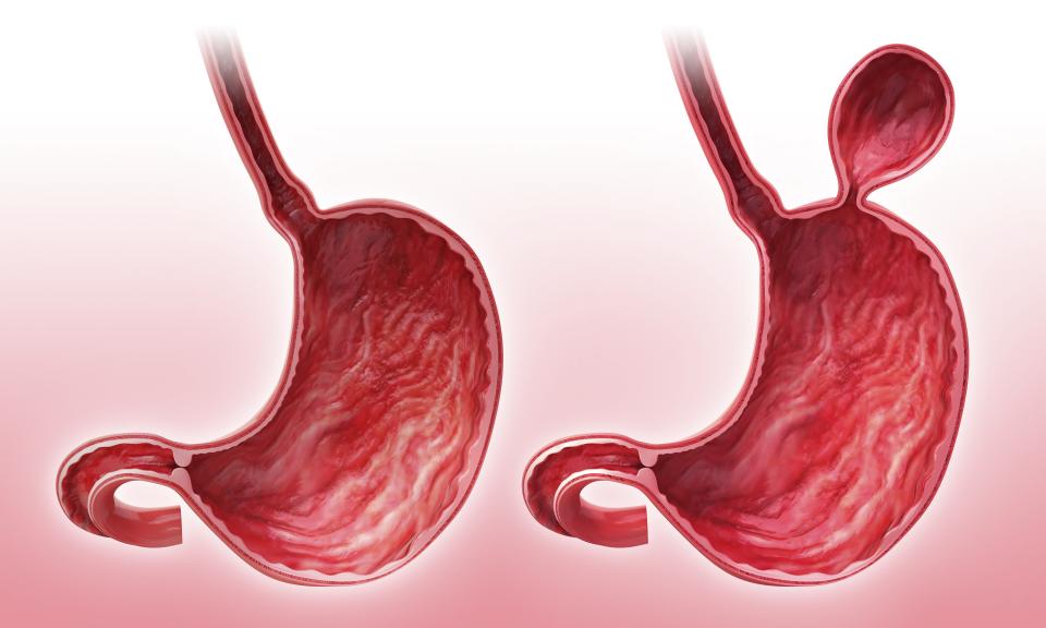 Hiatal hernia