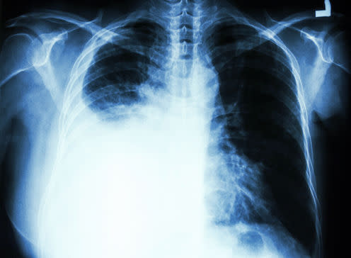 <span class="caption">X-ray of person with lung cancer.</span> <span class="attribution"><a class="link " href="https://www.shutterstock.com/download/confirm/496563448?src=52HnDIPEYNTPAS9ShXlmHA-1-11&size=medium_jpg" rel="nofollow noopener" target="_blank" data-ylk="slk:Puwadol Jaturawutthichai/Shutterstock;elm:context_link;itc:0;sec:content-canvas">Puwadol Jaturawutthichai/Shutterstock</a></span>