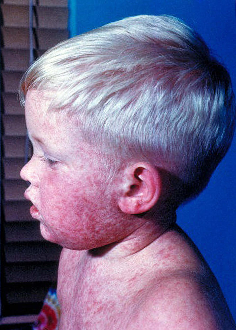 Measles rashes sometimes appear blotchy. (Courtesy Centers for Disease Control and Prevention)