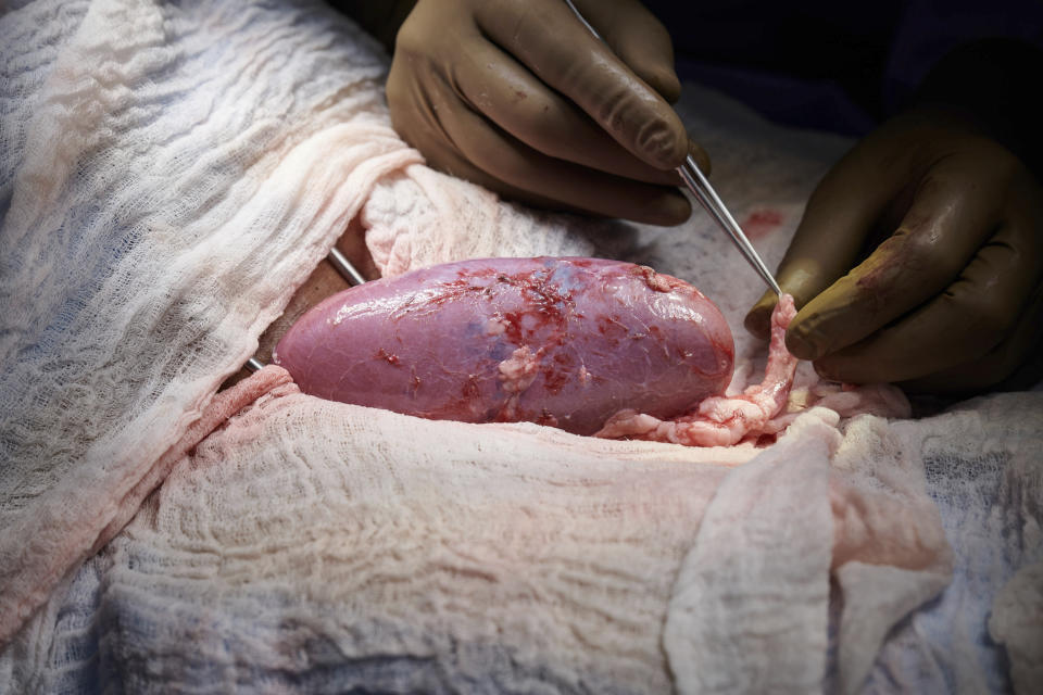 In this September 2021 photo provided by NYU Langone Health, a surgical team at the hospital in New York examines a pig kidney attached to the body of a deceased recipient for any signs of rejection. The test was a step in the decades-long quest to one day use animal organs for life-saving transplants. (Joe Carrotta/NYU Langone Health via AP)