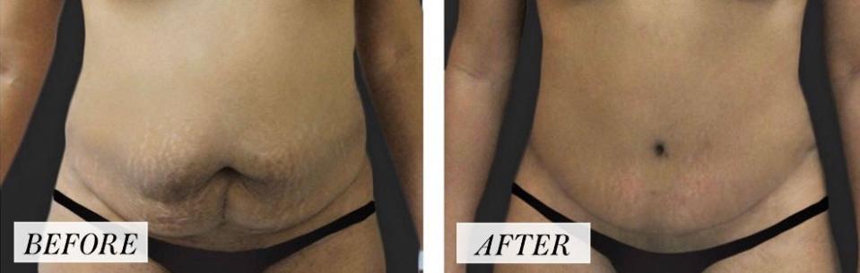 <h1 class="title">Life in Plastic: Tummy Tuck before-and-after images.jpg</h1><cite class="credit">Courtesy of Melissa A. Doft, MD</cite>