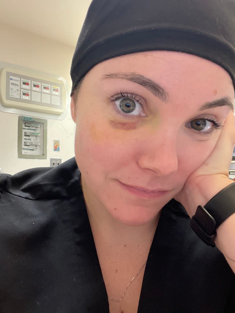 Colleen Leahy was left with bruised right eye after Johnson allegedly punched her in July 2022. Courtesy of Colleen Leahy