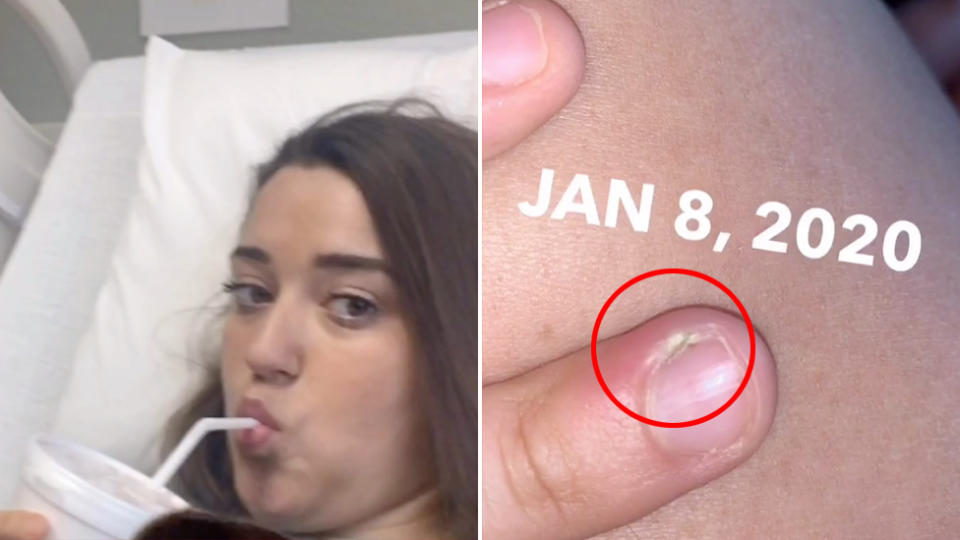 Lauren Nichols in hospital (left) after her nail biting lead to an infection (right is her finger).