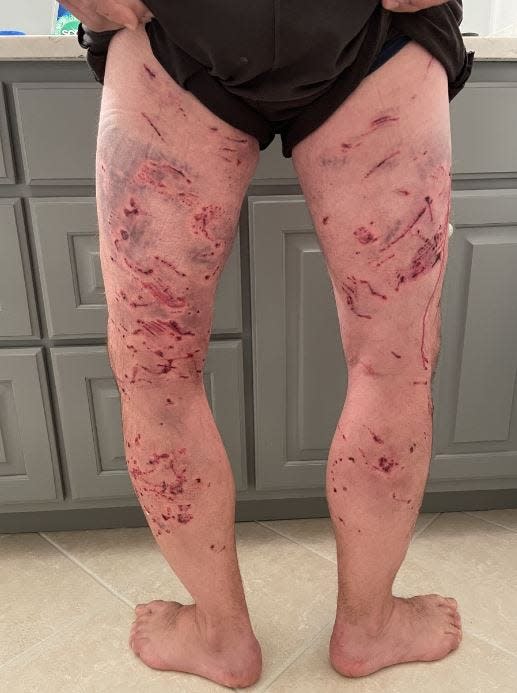The victim of a dog attack in a Jackson County forest shows some of the bite marks on his legs.