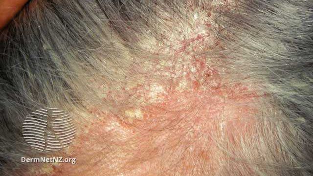 seborrheic dermatitis