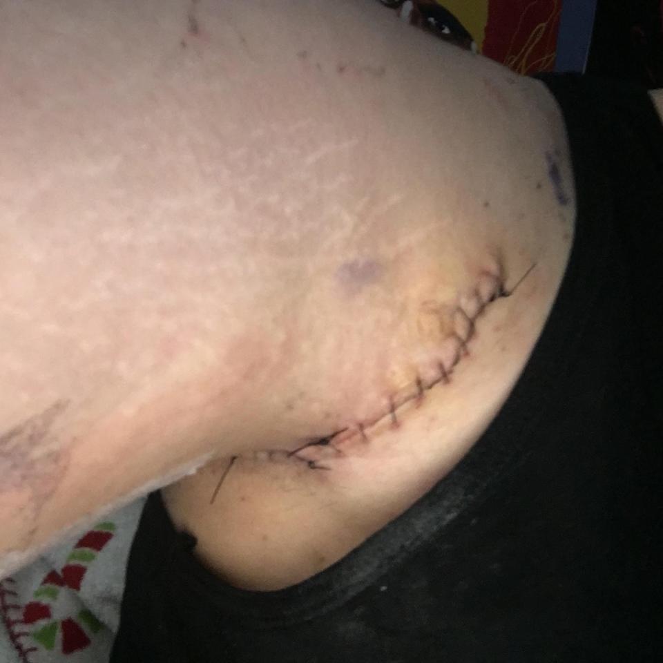 Selina Ferragamo's arm post-HS surgery