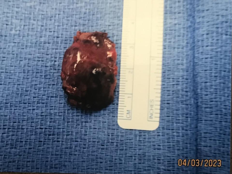 One of two tumors removed from Janet Alessi's parathyroid glands. If she had heeded earlier advice, they might not have grown to the size of strawberries — a bigger challenge for surgeons and a bigger threat to her health.