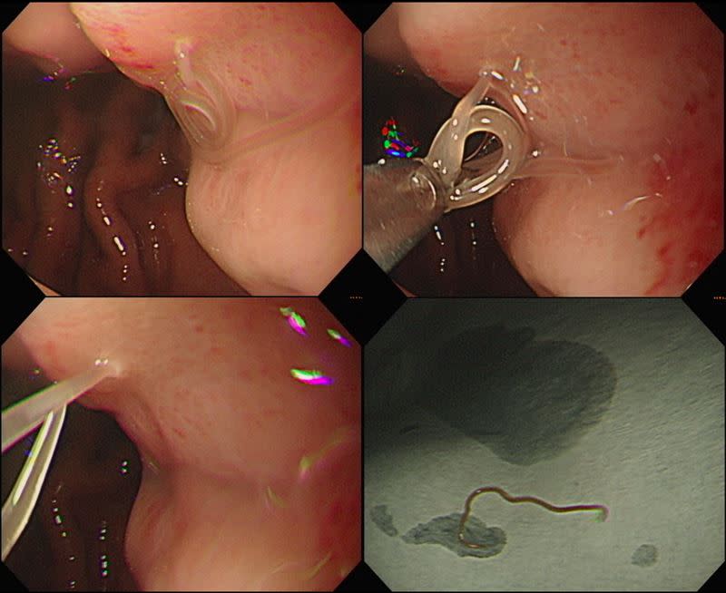 51歲男子大吃生魚片後竟解黑便、頭暈心悸，就醫檢查發現賁門有條2公分長的「海獸胃線蟲」在蠕動。（圖／烏日林新醫院提供）