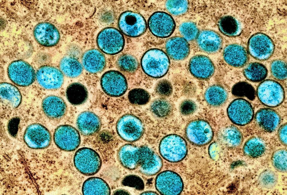 <span class="caption">Magnified and colourized monkeypox virus particles. Since early May, over 550 confirmed cases of human infection with monkeypox virus have been reported in 30 countries. </span> <span class="attribution"><span class="source">(NIAID)</span>, <a class="link " href="http://creativecommons.org/licenses/by/4.0/" rel="nofollow noopener" target="_blank" data-ylk="slk:CC BY">CC BY</a></span>