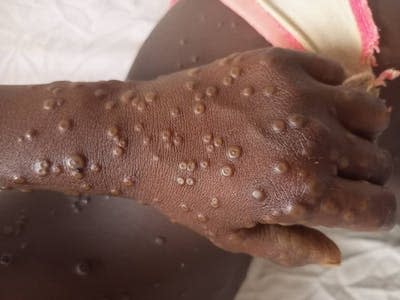 Lésions cutanées de mpox chez une enfant, à Bangui, en République centrafricaine, où circule le clade I du virus. Dr Festus Mbrenga / Institut Pasteur de Bangui - 2022, Fourni par l'auteur