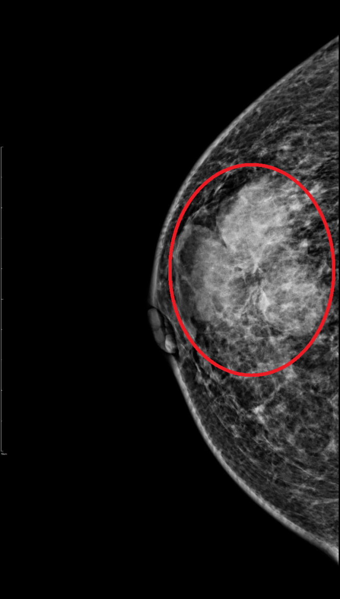 張小姐乳房X光攝影。（圖／烏日林新醫院）