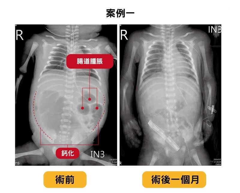 迴腸有腸道閉鎖合併腸扭轉與破腸穿孔，切除部分壞死腸道，並執行腸造口手術，讓出生兩天女嬰術後能夠正常吸收營養。（圖／翻攝畫面）