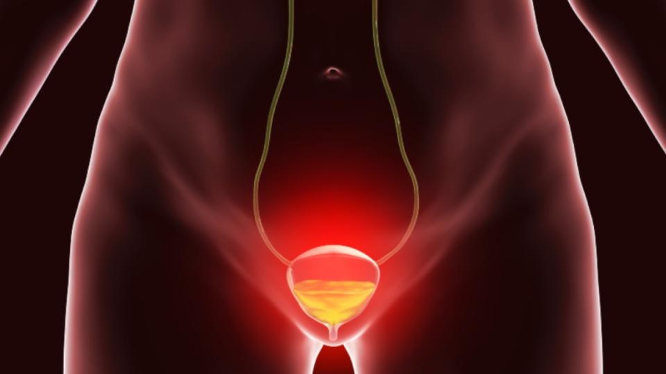 An illustration of an irritated bladder, a symptom of interstitial cystitis