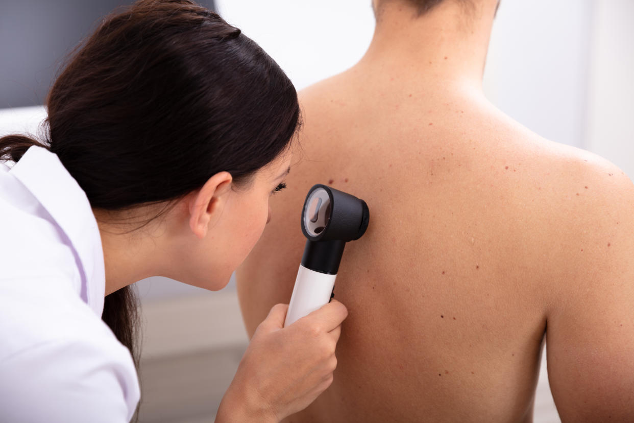 Female Doctor Examining Pigmented Skin On Man's Back With Dermatoscope