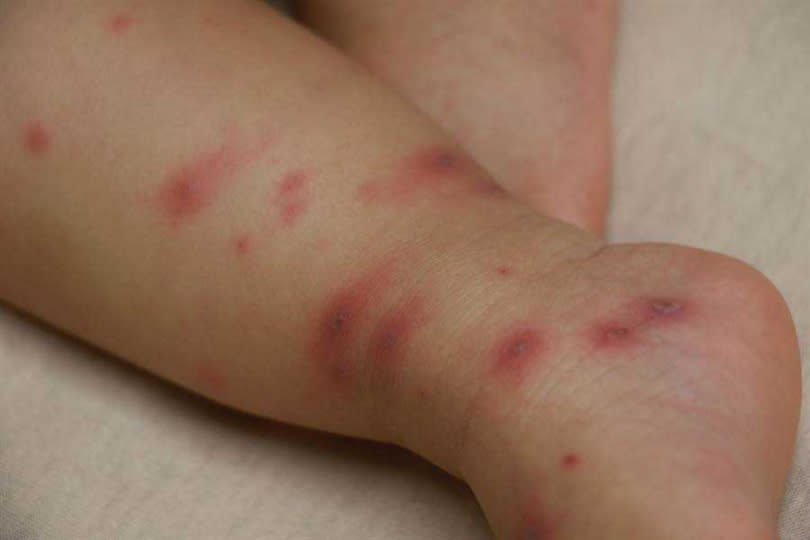 反覆高燒的小女嬰軀幹、四肢，甚至嘴巴都出現紅疹、紅色丘疹。（圖／台中慈濟醫院提供、中國時報王文吉台中傳真）