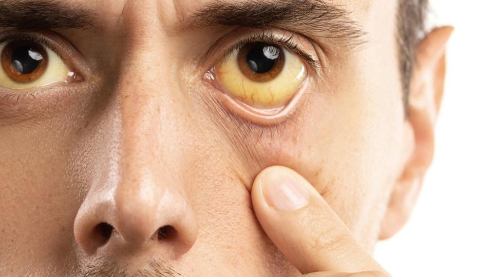 Un hombre se estira el ojo, que presenta un color amarillo: Un cambio en 