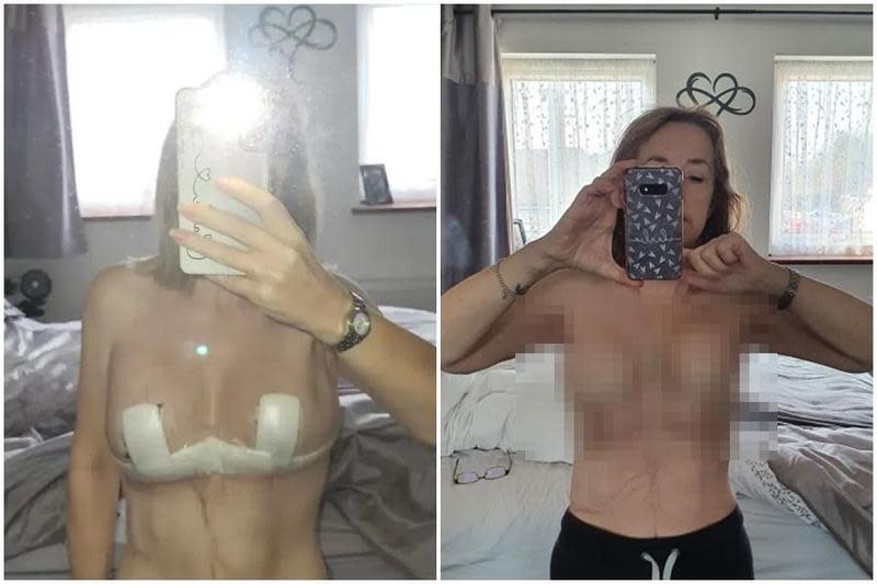 英國一名婦人在土耳其浴到黑心診所，害她一度有4個胸部。（翻攝自《太陽報》）
