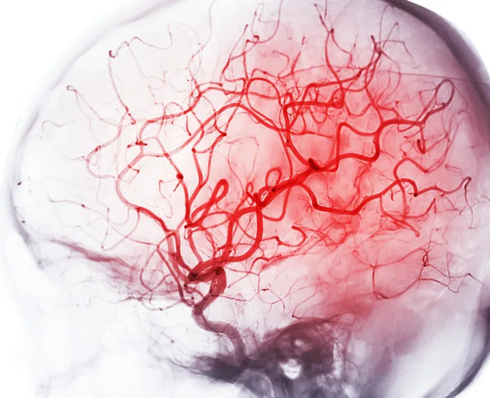 Blood carries oxygen and vital nutrients to the brain. <a href="https://www.gettyimages.com/detail/photo/cerebral-angiography-image-from-fluoroscopy-in-royalty-free-image/1473413961" rel="nofollow noopener" target="_blank" data-ylk="slk:Mr. Suphachai Praserdumrongchai/iStock via Getty Images;elm:context_link;itc:0" class="link ">Mr. Suphachai Praserdumrongchai/iStock via Getty Images</a>