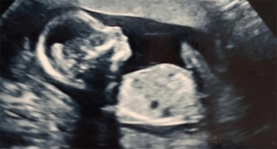 An ultrasound image of baby Amalie Maya. Source: JustGiving.com