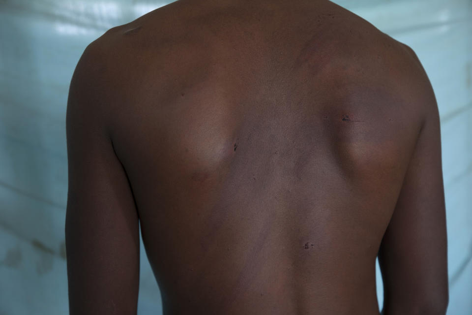 Adhanom Gebrehanis, a 20-year-old Tigrayan refugee from Korarit village, shows the welts on his back from a beating by Eritrean soldiers, after a checkup at the Sudanese Red Crescent clinic shortly after his arrival in Hamdayet, eastern Sudan, near the border with Ethiopia, on March 18, 2021. "They do these things openly to make us ashamed." He described watching Eritreans pull aside 20 women from a group of Tigrayans and rape them. The next day, 13 of the women were returned. (AP Photo/Nariman El-Mofty)